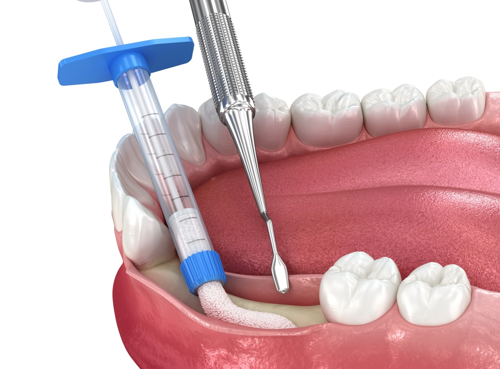 Bone Grafting: Building Blocks for Dental Implants